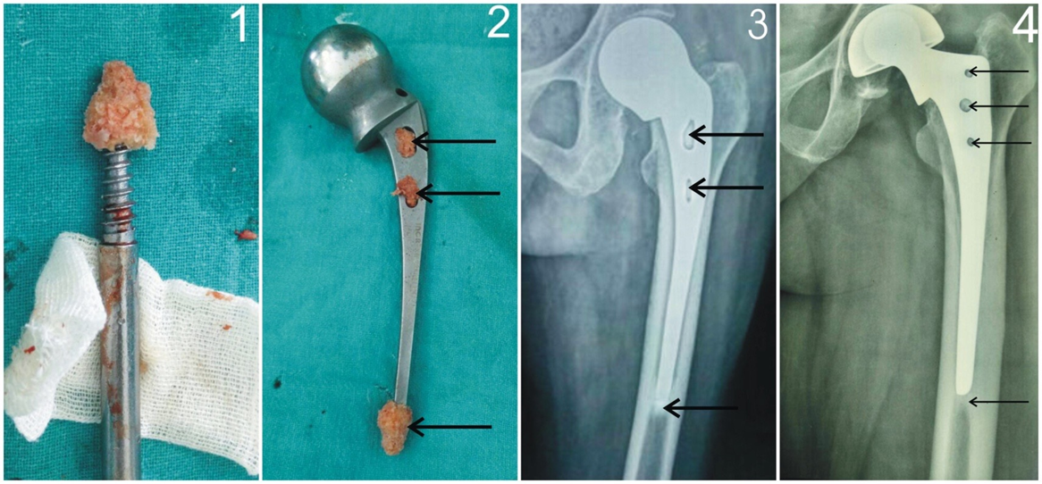 Use of Double Bone Graft to Stabilize Prosthesis in Uncemented Partial Hip Replacement in Elderly Patients with Fracture Neck of Femur