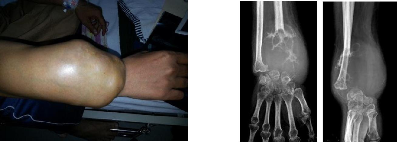 Centralization of Ulna in Treatment of Giant Cell Tumor of Distal Radius - A Case Report