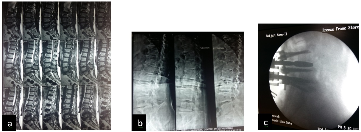 Prospective analysis of clinico-radiological efficacy of Trans-foraminal Lumbar Interbody Fusion (TLIF) in degenerative disc disease - Mid term follow up of 2 years