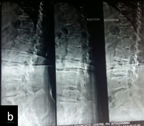 Prospective analysis of clinico-radiological efficacy of Trans-foraminal Lumbar Interbody Fusion (TLIF) in degenerative disc disease - Mid term follow up of 2 years