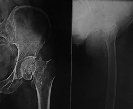 Neck of femur fracture secondary to bone infarcts of proximal femur- A rare case report