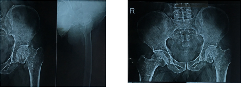 Neck of femur fracture secondary to bone infarcts of proximal femur- A rare case report